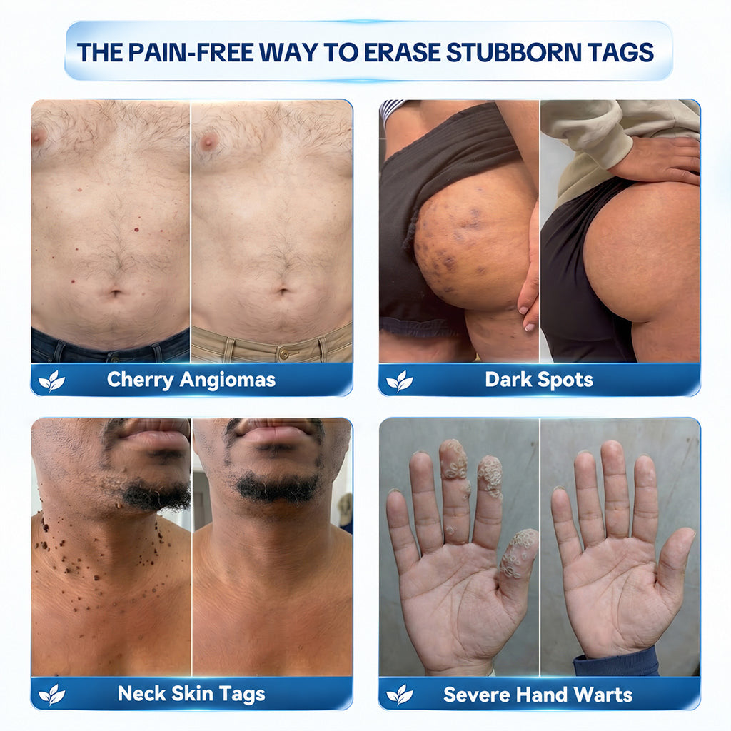 Dyceco® 🍒7-𝐃𝐚𝐲 𝐒𝐤𝐢𝐧 𝐓𝐚𝐠 & 𝐒𝐩𝐨𝐭 𝐄𝐫𝐚𝐬𝐞𝐫 𝐂𝐫𝐞𝐚𝐦 (Zero Pain, Zero 𝐒𝐜𝐚𝐫𝐬 Formula)