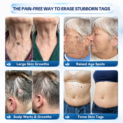 Dyceco® 🍒7-𝐃𝐚𝐲 𝐒𝐤𝐢𝐧 𝐓𝐚𝐠 & 𝐒𝐩𝐨𝐭 𝐄𝐫𝐚𝐬𝐞𝐫 𝐂𝐫𝐞𝐚𝐦 (Zero Pain, Zero 𝐒𝐜𝐚𝐫𝐬 Formula)
