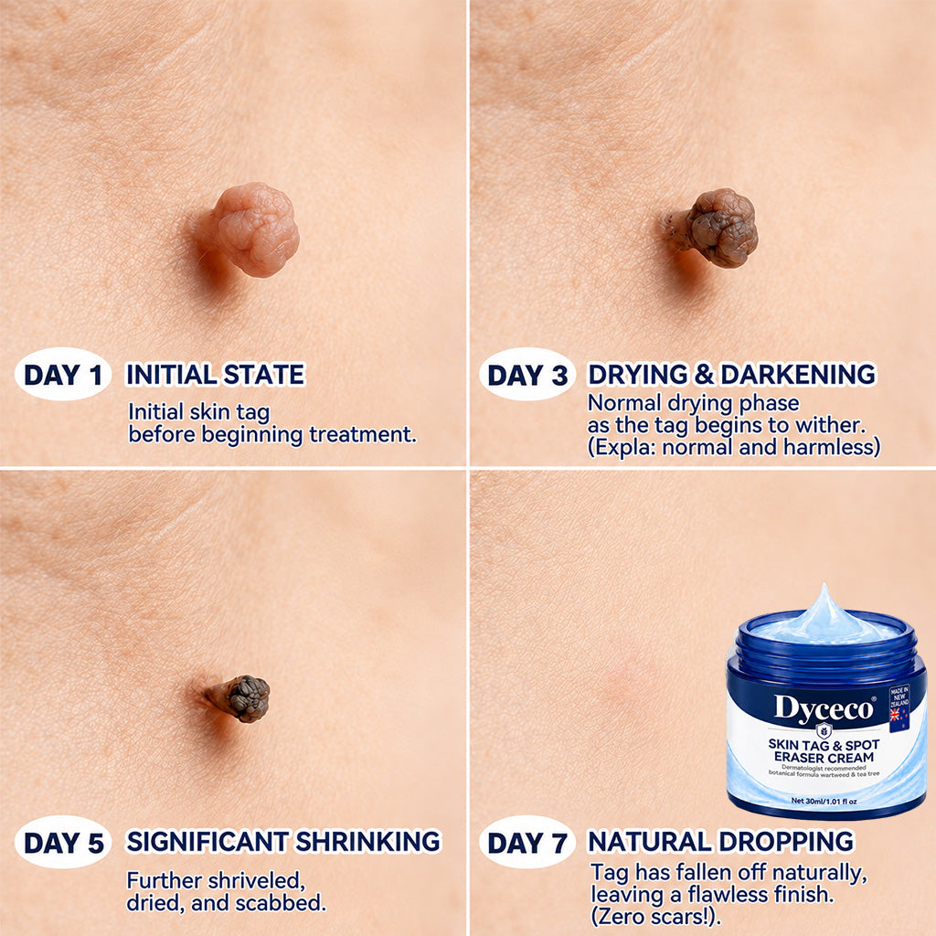 Dyceco® 🍒7-𝐃𝐚𝐲 𝐒𝐤𝐢𝐧 𝐓𝐚𝐠 & 𝐒𝐩𝐨𝐭 𝐄𝐫𝐚𝐬𝐞𝐫 𝐂𝐫𝐞𝐚𝐦 (Zero Pain, Zero 𝐒𝐜𝐚𝐫𝐬 Formula)
